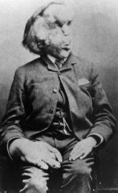 Joseph Merrick